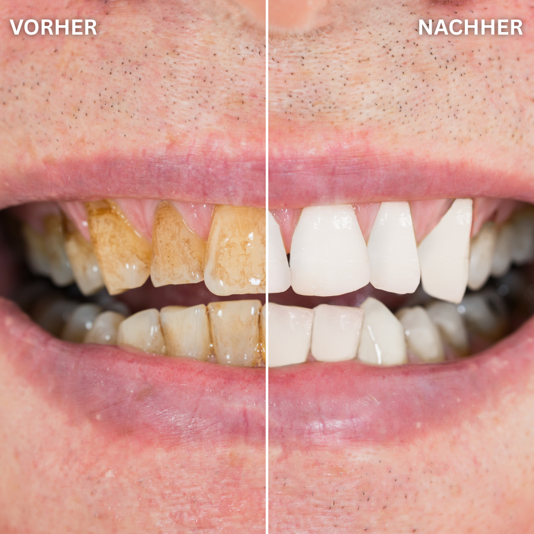 Zahnreiniger - Entfernt effektiv gelben Zahnstein